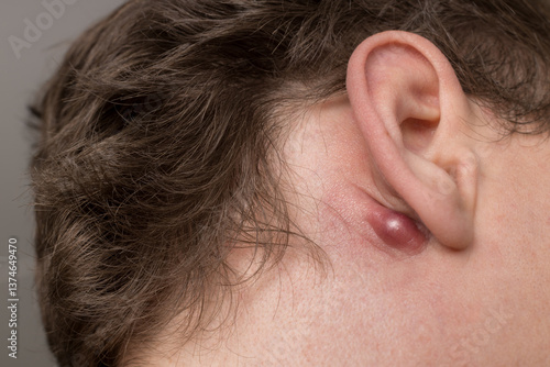 Photos Caucasian man haves - cysts behind the ear - inflammation in body