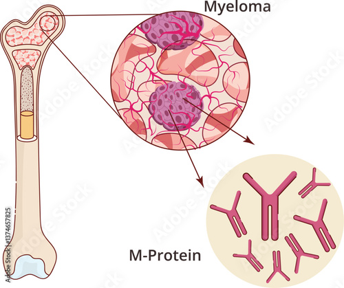 Myeloma pathology illustration. Illustration of a bone marrow with cancer producing M-protein