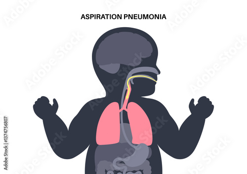 Aspiration pneumonia poster
