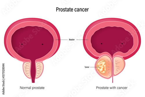 Prostate cancer. Comparison between normal prostate and prostate with cancer. Prostatitis is inflammation of the prostate gland. Male reproductive system disease.