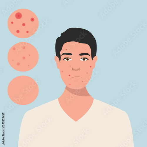 Young men has skin problems with acne or allergic pimples on her face. Skincare and dermatology concept. Flat style vector illustration.