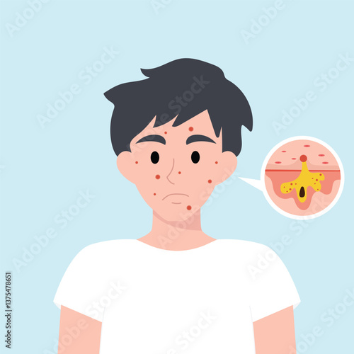 Teenager boy has skin problems with acne or allergic pimples on her face. Skincare and dermatology concept. Flat style vector illustrationv