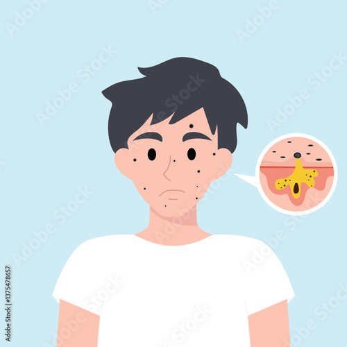 Teenager boy has skin problems with acne or allergic pimples on her face. Skincare and dermatology concept. Flat style vector illustrationv