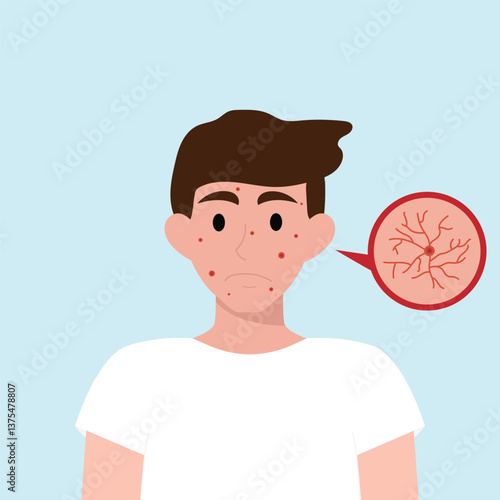 Teenager boy has skin problems with acne or allergic pimples on her face. Skincare and dermatology concept. Flat style vector illustrationv