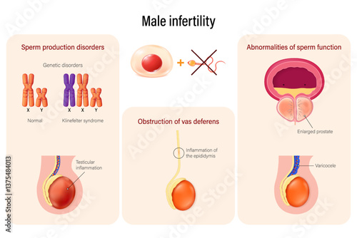 Male infertility. Causes of infertility in male. Male reproductive system.