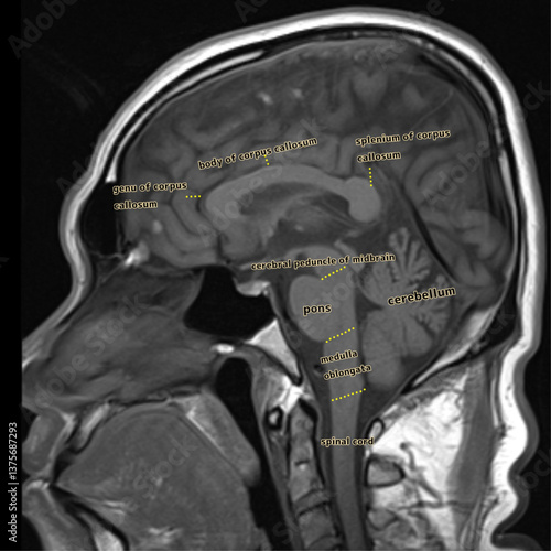Normal brain stem MRI image sagital anatomy 