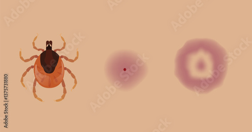 Tick biting skin causing Lyme disease and erythema migrans rash
