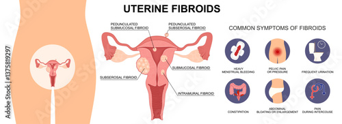 Uterine Fibroids Types and Symptoms. Medical Vector Illustration