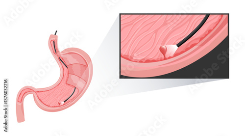 Polyp removal procedure in stomach. Polyp is under magnification. Vector illustration