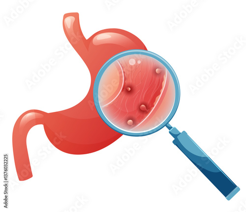 Stomach polyps, multiple gastric polyps under magnification. Digestive system disorder.Medical vector illustration.