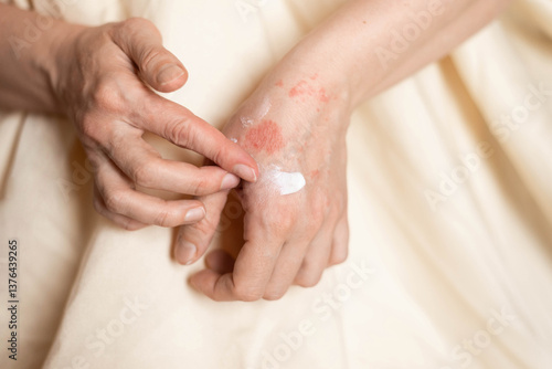 Itching on hands with redness rash. Cause of itchy skin include dermatitis (eczema), dry skin, burned, food,drug allergies, insect bites. Health care concept.