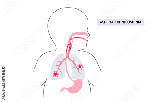 Aspiration pneumonia poster