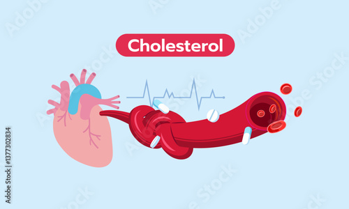 Blood vessels to the heart containing blood cells, with an artery blocked and clogged by cholesterol