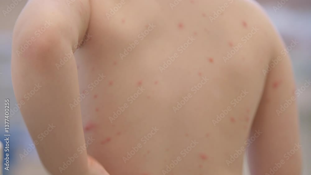 Child with a Skin Rash chickenpox located on Their Back A Guide for Parents Seeking Assistance Child with a Skin Rash chickenpox located on Their Back A Guide for Parents Seeking Assistance