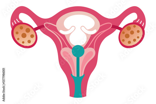Female Reproductive System Uterus, Fallopian Tubes, Ovaries Showing Polycystic Ovary Syndrome or Other Conditions