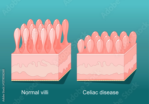 Coeliac disease. celiac disease. Gluten intolerance