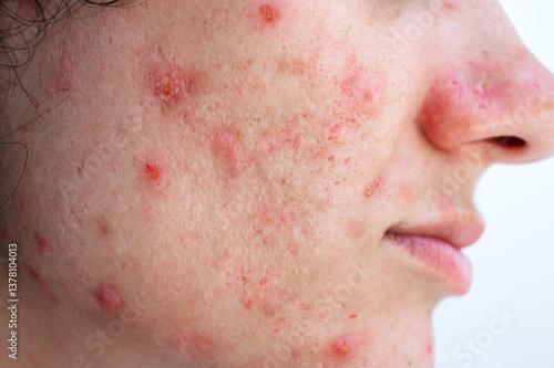 female face of a young woman with acne and pimples on skin with problem close up on white background