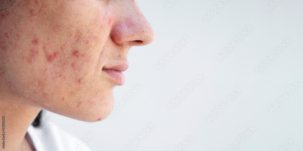 female face with acne and pimples on problem skin closeup on isolated white background female face with acne and pimples on problem skin closeup on isolated white background