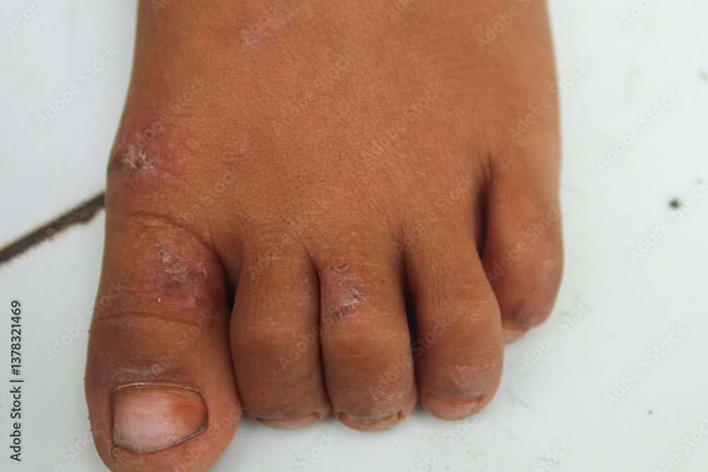 Naklejka premium psoriasis on the skin of a child's feet close up