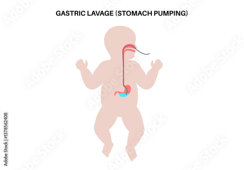 Stomach wash gastric lavage