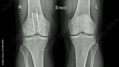 Real Human Patella Fracture Fixation Radiograph Showing Surgical Repair