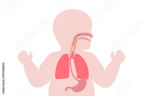 Aspiration pneumonia poster