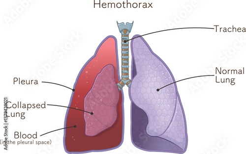 肺・気管・気胸・血胸・血気胸のイラスト lungs,windpipe,hemothorax,pneumothorax,hemopneumothorax,illustration