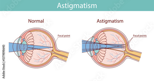 astigmatism. sick eye. vector illustration in cartoon style