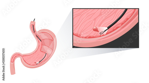 Procedure of stomach polyp removal using with an endoscope. concept gastroenterology, digestive health treatment. Vector medical illustration.