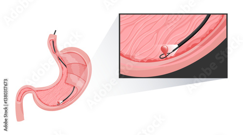 Removal polyp in stomach. Enlarged view of endoscope grasping polyp with loop. Vector medical illustration.