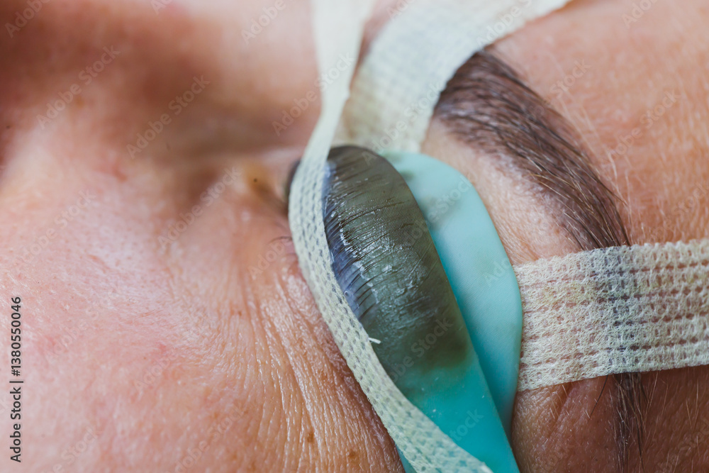 This closeup image showcases a Medical Eye Procedure, highlighting the application of a Protective Eye Covering and the careful placement of a Contact Lens, emphasizing safety and intricate details