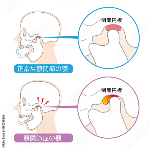 顎関節症の症状と説明のイラスト