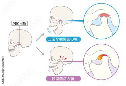 顎関節症の症状と説明のイラスト