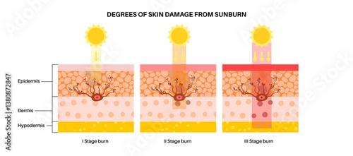 Skin damage from sunburn