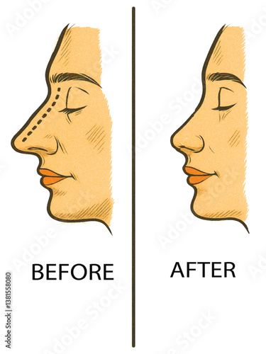 Vector illustration comparing a nose before and after rhinoplasty. Isolated design on white background. ideal for medical and cosmetic visuals.