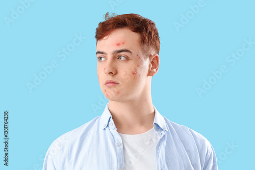 Teenage boy with acne on bl...