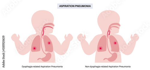 Aspiration pneumonia poster
