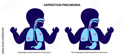 Aspiration pneumonia poster