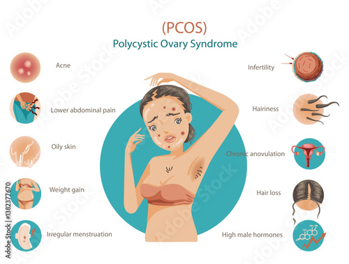 Polycystic Ovary Syndrome Symptoms