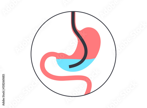 Stomach wash gastric lavage