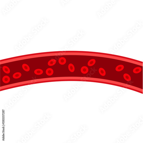 Blood vessel flow and arteriosclerosis. Atherosclerosis Diagram. Vector illustration.
