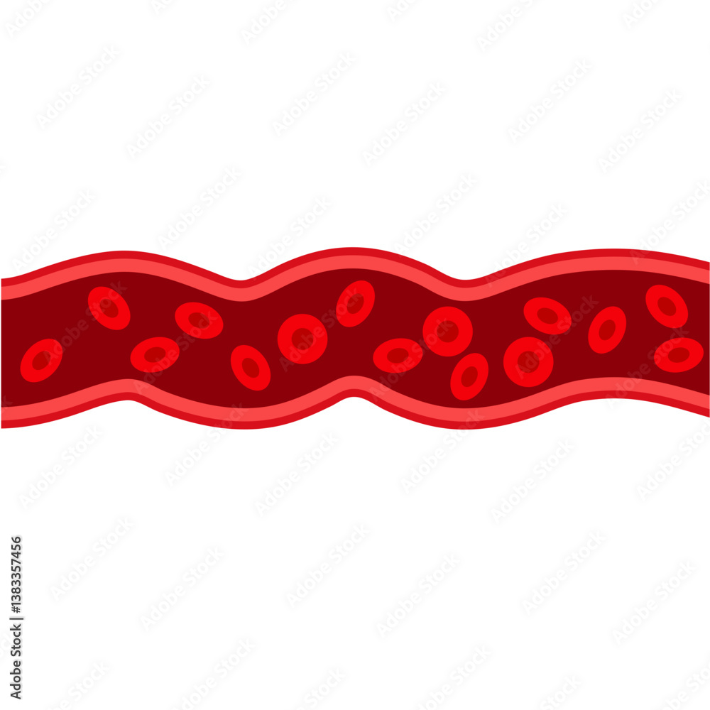 Blood vessel flow and arteriosclerosis. Atherosclerosis Diagram. Vector illustration.
Blood vessel flow and arteriosclerosis. Atherosclerosis Diagram. Vector illustration.
