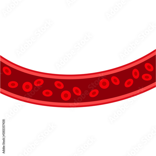 Blood vessel flow and arteriosclerosis. Atherosclerosis Diagram. Vector illustration.
