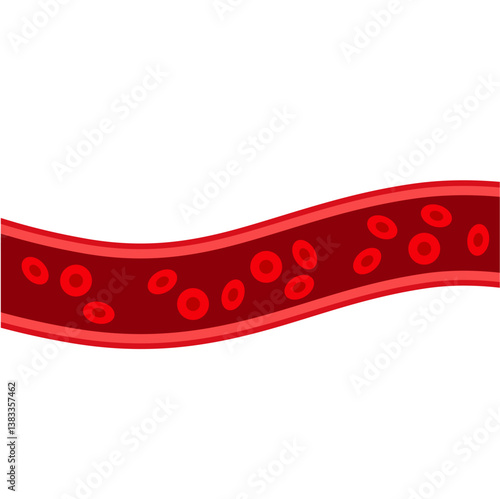 Blood vessel flow and arteriosclerosis. Atherosclerosis Diagram. Vector illustration.
