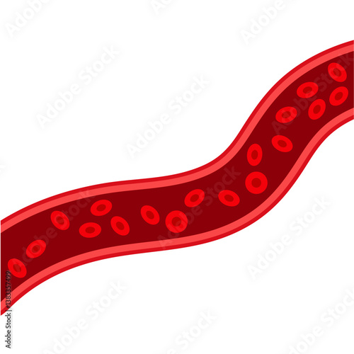 Blood vessel flow and arteriosclerosis. Atherosclerosis Diagram. Vector illustration.
