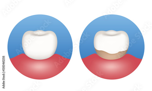 Tartar. Tooth with and without tartar. Vector illustration.