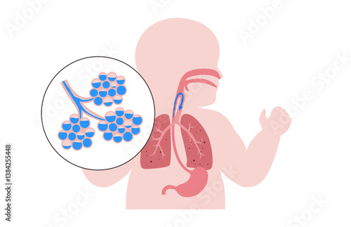 Aspiration pneumonia poster