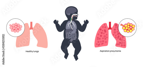 Aspiration pneumonia poster