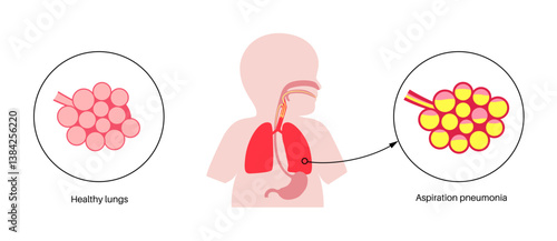 Aspiration pneumonia poster