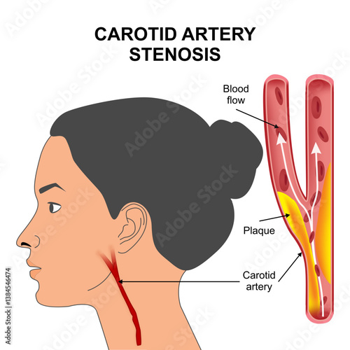 Carotid Artery Stenosis Medical Illustration